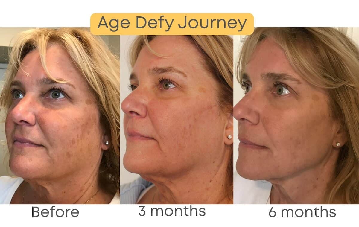 Age Defy Journey Before - 3 months - 6 months - 3